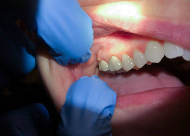 Best Emergency Dental Care for Broken or Chipped Teeth in Maple Plain, MN