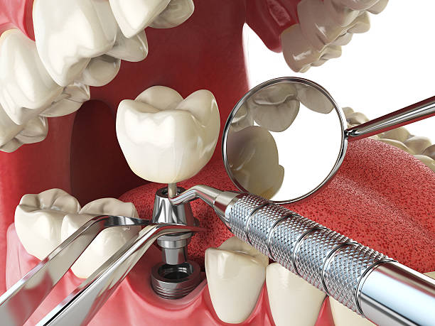 Best Emergency Dental Care for Broken or Chipped Teeth in Maple Plain, MN